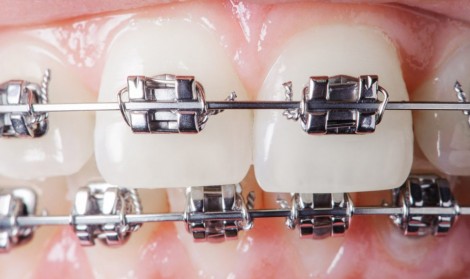 مزیت استفاده از ارتودنسی دیمون دندان 